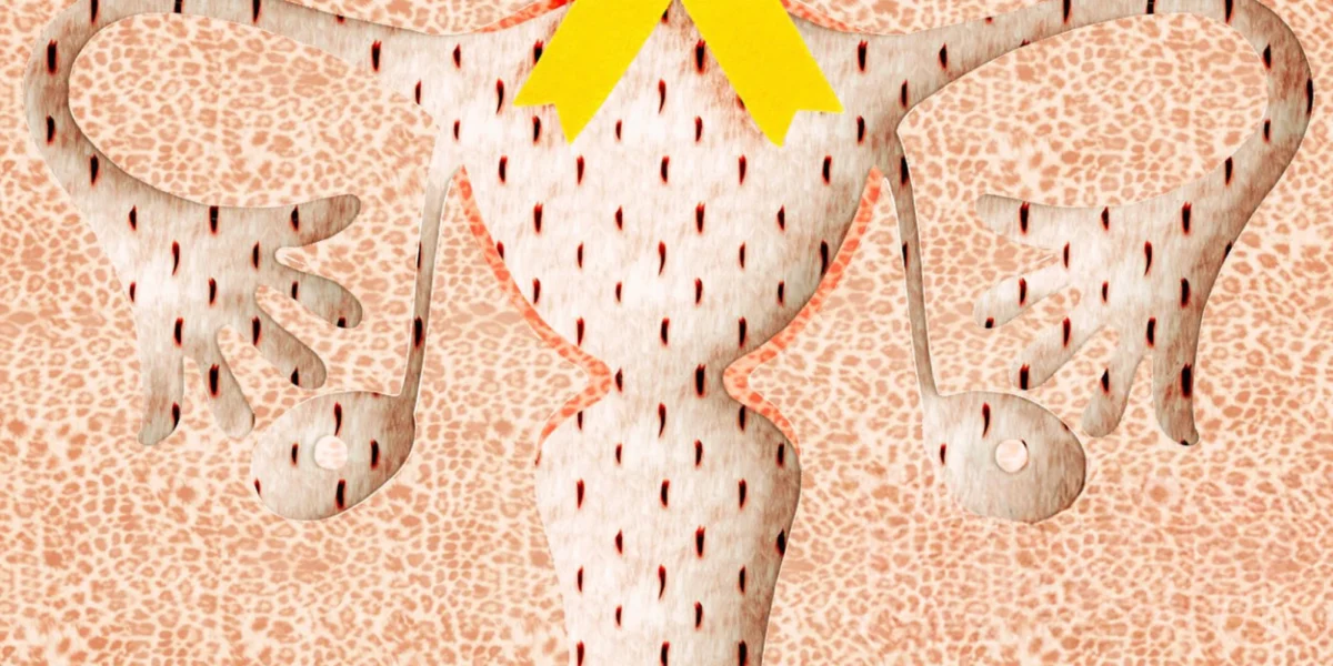 Symptoms of endometriosis